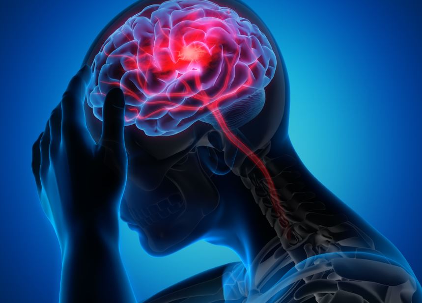 Proven Strategies for Migraine Without Aura Treatment
